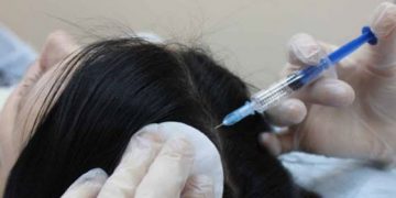 Ozon-Injektionstherapie für Haare